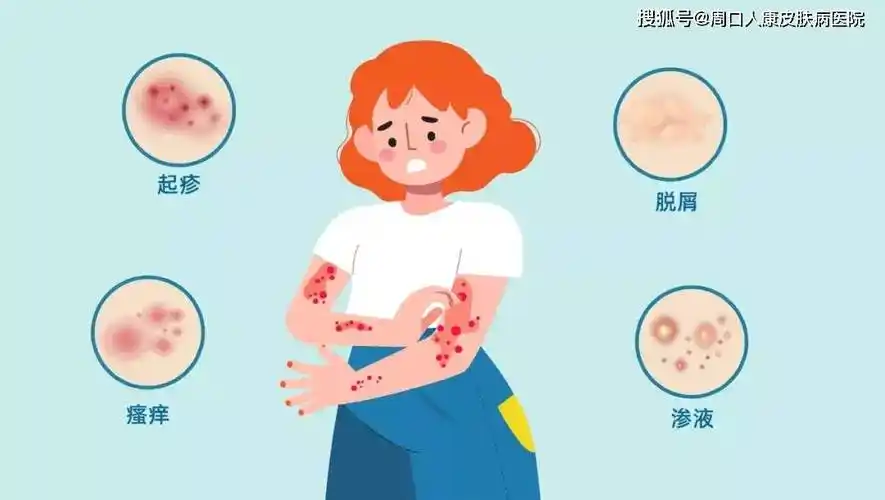 【周口人康皮肤病医院】皮炎会不会引起脱皮呢?_症状_细胞_现象