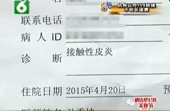 小包连夜去了杭州市三医院,一检查,接触性皮炎,说是挺严重,得住院治疗