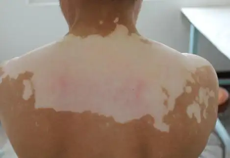 白斑病的治疗方法有哪些