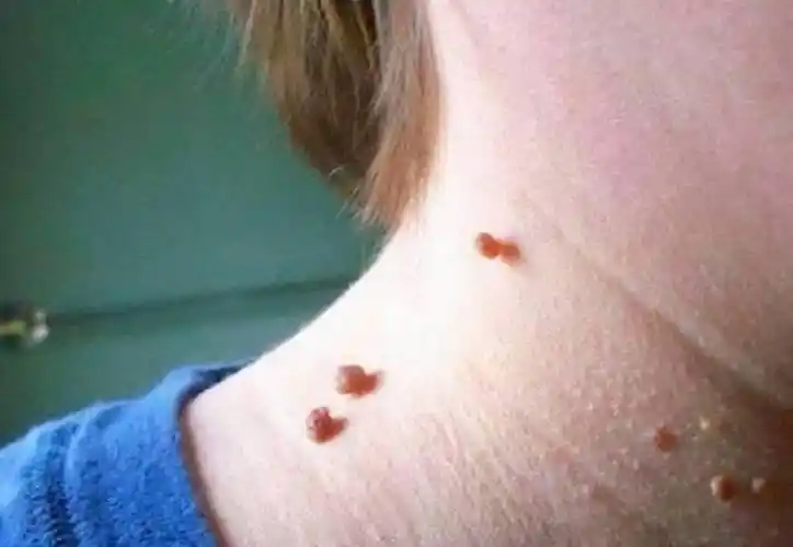 脖子上长了小肉粒碍事吗要不要治疗医生说明白了