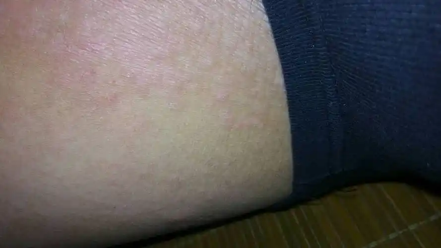 这到底是什么情况?啊 男性 大腿内侧