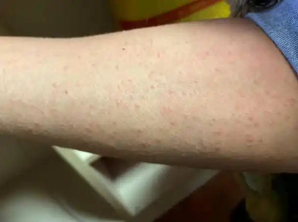 这些皮肤症状,有可能是艾滋病!你知道艾滋病应该如何检测吗?