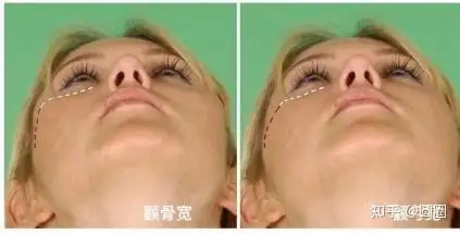 三,高低颧骨的区别