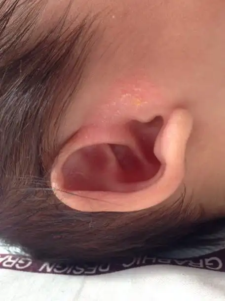 婴儿湿疹引起耳朵流脓怎么办_婴儿湿疹长到耳朵里_宝宝耳朵起湿疹怎么