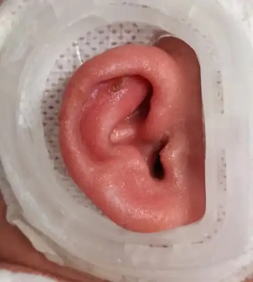 新生宝宝耳廓畸形,出生21天内有机会无创矫正_家庭健康终端_京智康