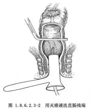 双吻合器前切除术