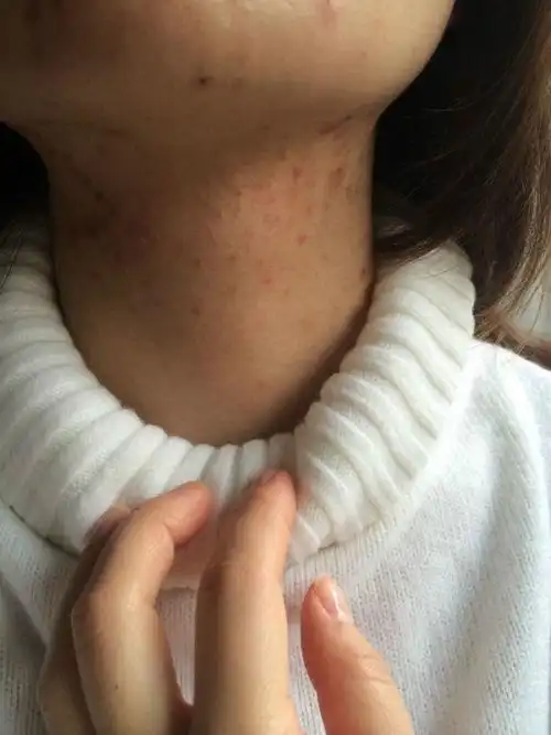 求救啊最近几个月脖子上长了好多痘痘不知道啥原因越来越严重