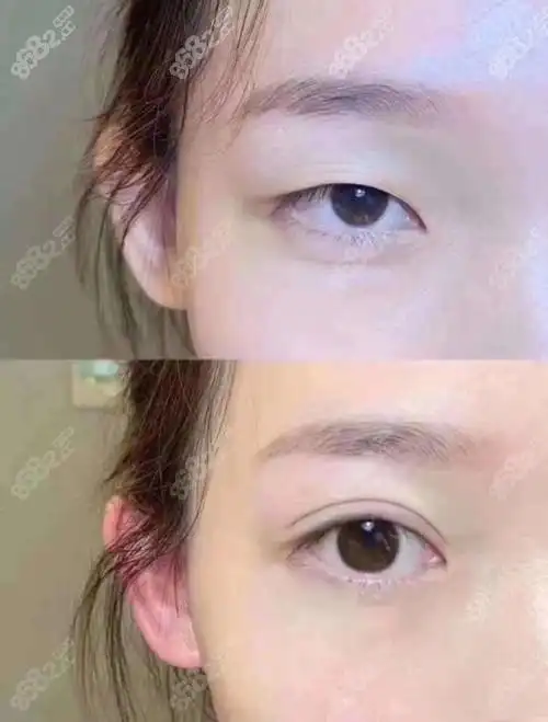 高士乾修复过宽双眼皮案例还不错,那全切双眼皮做的好?