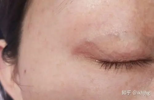 埋线双眼皮出现线结怎么办 - 知乎