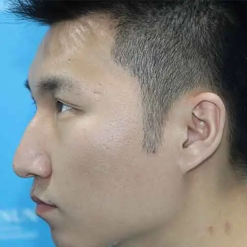 种植鬓角已经五个月了,现在恢复很好,趁着今天有时间_圈子-新氧美容