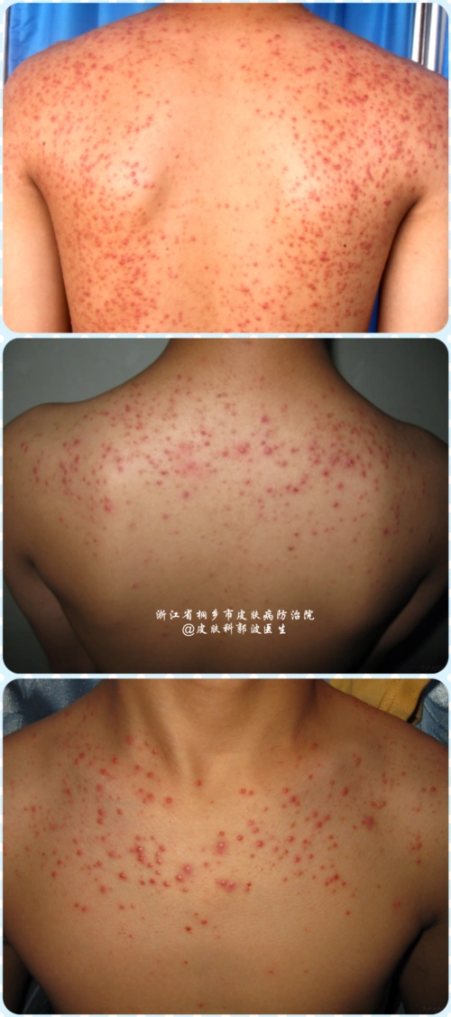 马拉色菌毛囊炎的防治