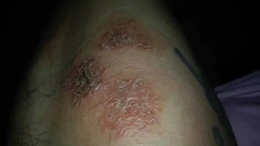 腿上长了一片不知道什么东西,有时候特别痒,有一个月了