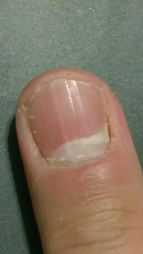 我的指甲根部 无故发白了,不痛不痛,如图. 有人知道这是怎么回事吗?