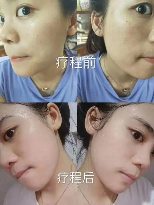 祛黄,美白,补水素颜对比照
