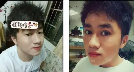 男生割双眼皮前后对比效果图
