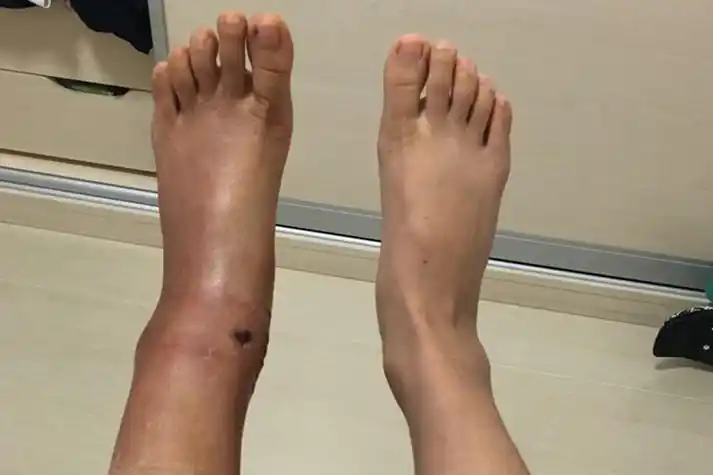 脚内侧疼凸起的骨头疼图片_有来医生