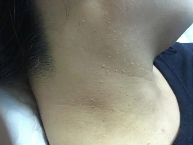 丝状疣的对比图片