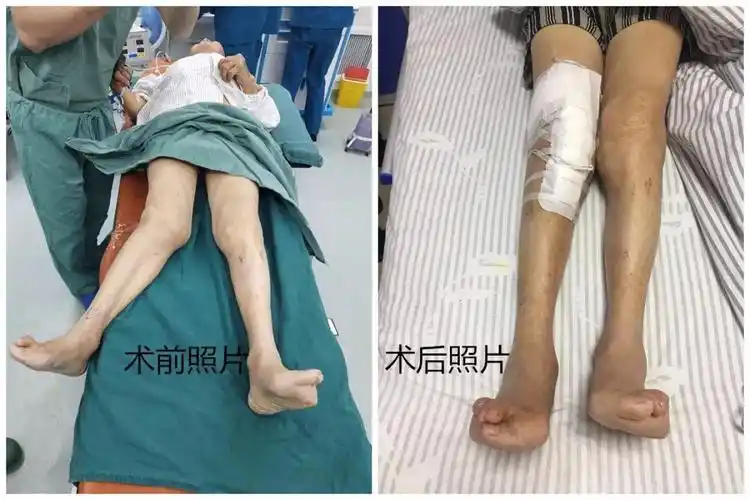临泉泉河医院痛了60年的膝关节终于不痛了