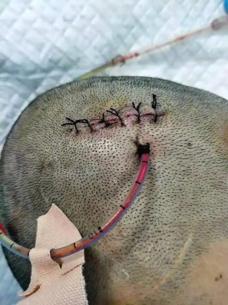 一场意外导致头部受伤… 一句会好的,我撑了一年零三个月 随着 - 抖音