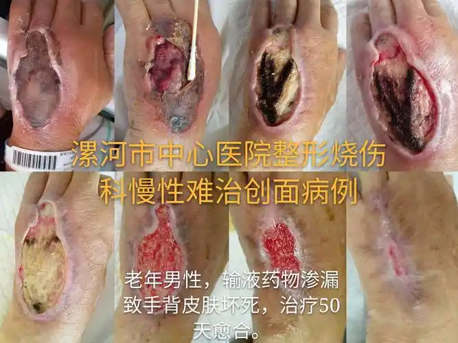 一例输液外渗致皮肤坏死的救治体会(满满干货,医护必读)