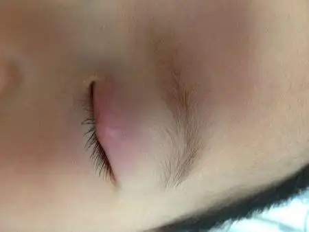 宝宝眼皮上长包,先开始是红的,这两天越来越紫了,还有点青,不知道哪位