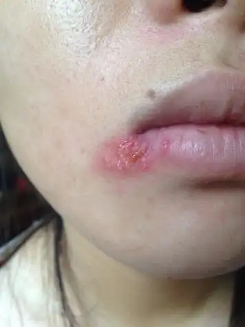 疱疹和上火水泡的区别图(单纯疱疹和上火水泡的区别图)