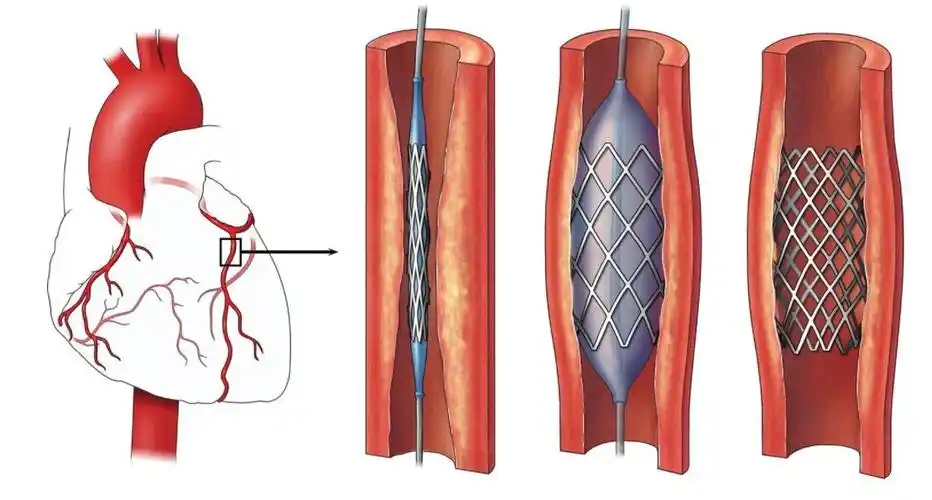 冠状动脉造影后如果进行了冠心病介入治疗,特别是植入冠脉支架的患者