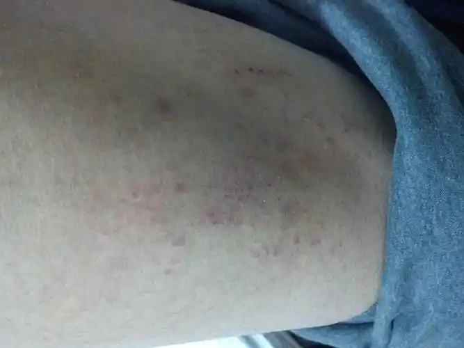 大家看看这是湿疹还是干燥性皮炎?