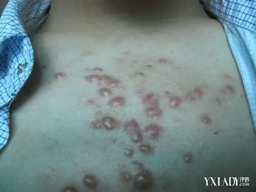 【图】胸口上长痘痘该怎么办 内分泌失调是引发胸口长痘的一大因素