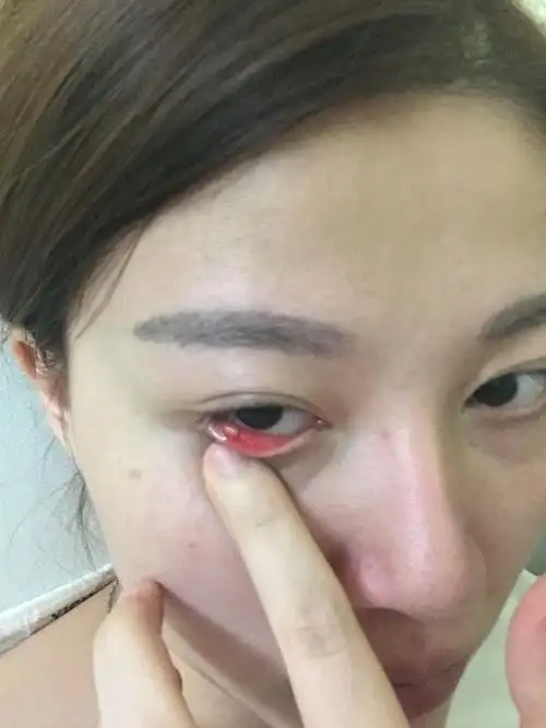 右眼长了两颗麦粒肿,外麦粒肿是不是一定要手术,不然长大撑破会毁容?