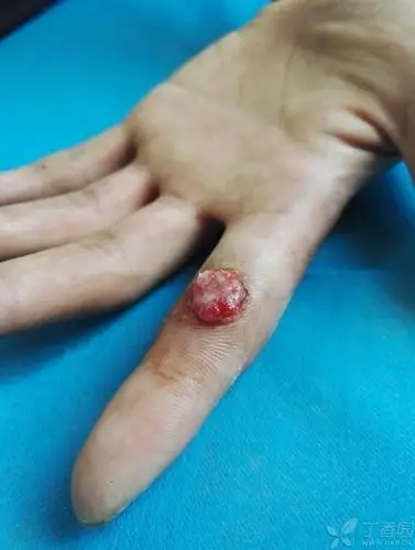 【讨论】左食指掌面炎性肉芽肿如何处理?
