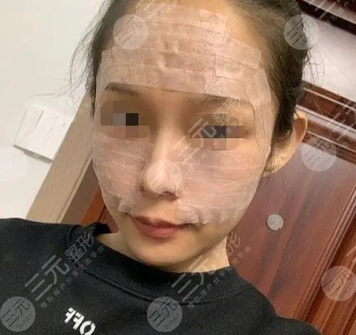 全脸脂肪填充5到10天照片拥有饱满幼幼脸的过程