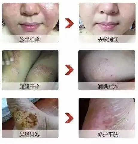 用于身体的各部位皮肤病效果奇特,2分钟见效,消除各种皮肤病问题.