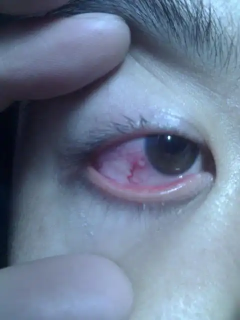 泡性角膜炎的介绍