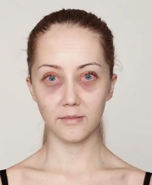 ▼第四天:她的脸上开始出现细纹, 尤其嘴角两侧更为明显,整张脸明显