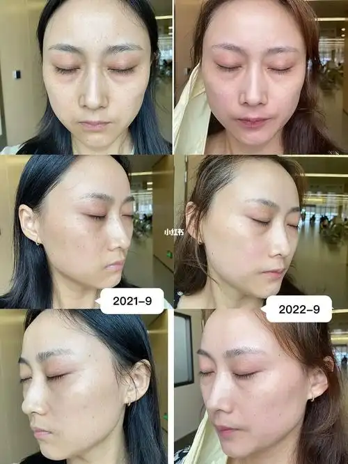 南通附院光子嫩肤m22,一年做了7次的变化