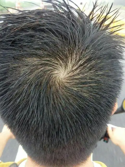 亲爱的白友们帮我看下,我32,透顶中间头发感觉有点少,正常吗?