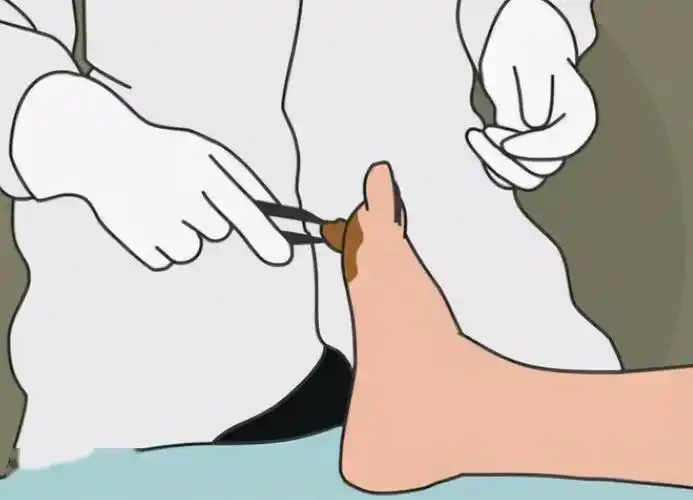 糖尿病病友请留心小小溃疡也可能引发截肢做对5件事很关键