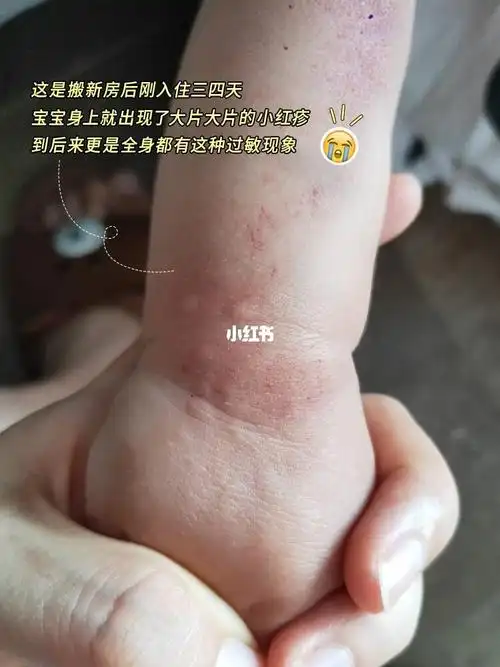 找专业机构除甲醛被骗,入住后宝宝全身过敏