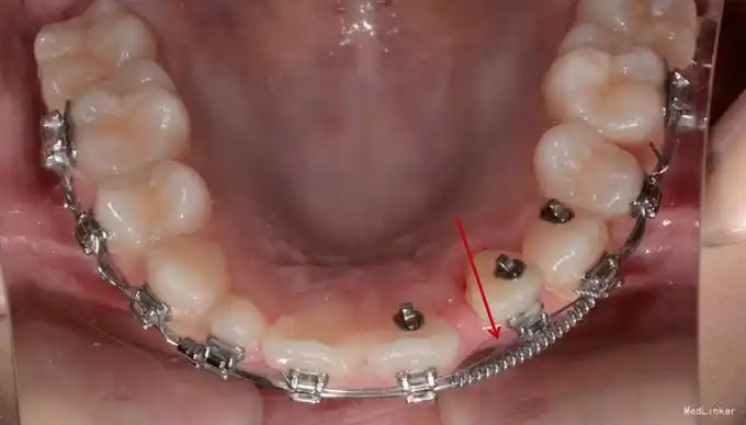 上颌侧切牙阻生一例