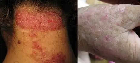 肤康资深医生带你认识皮炎皮炎种类,图片以及如何治疗_太原皮肤科哪家