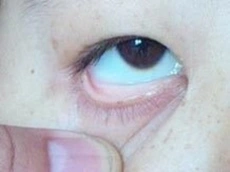 贫血患者结膜苍白