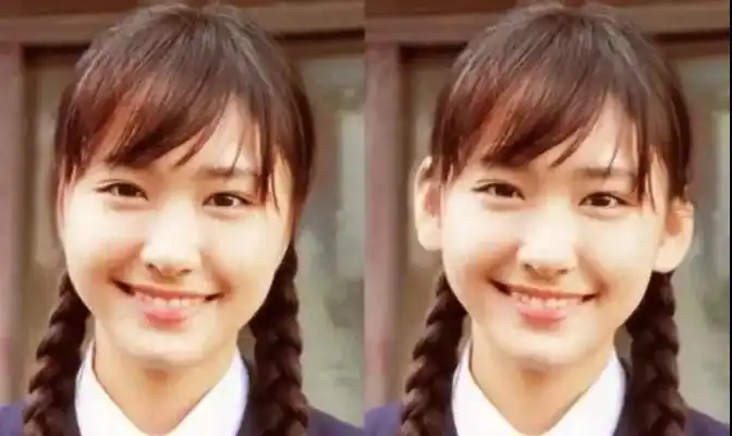 "贴面耳"又被称为"贴脑耳","贴发耳","敷面耳"等,具体表现为耳廓与