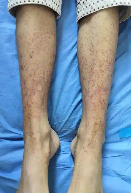 紫癜的症状是出血点紫癜和瘀斑,一般不高出皮肤过敏性紫癜大多以皮肤