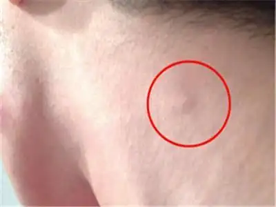 脖子有肿块是淋巴癌?6个症状还需警惕,及时发现能救你一命!