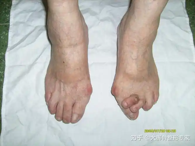 糖尿病足的,太吓人,这里就不发了因为她前些时间找我做过大脚骨手术