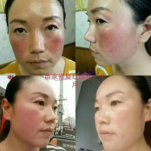 红血丝后修复前后对比图