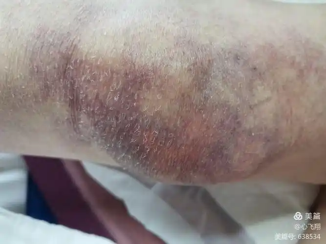 皮肤花斑