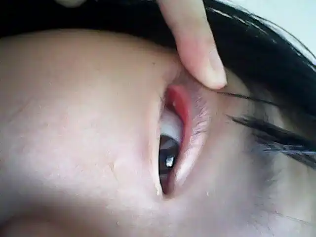 上眼皮有麦粒肿,红,但是不疼.