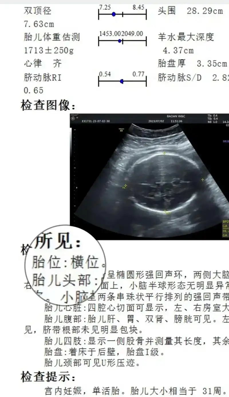 胎位横位.31周发现胎位不正,太难了,这个需要及时调整,不然 - 抖音
